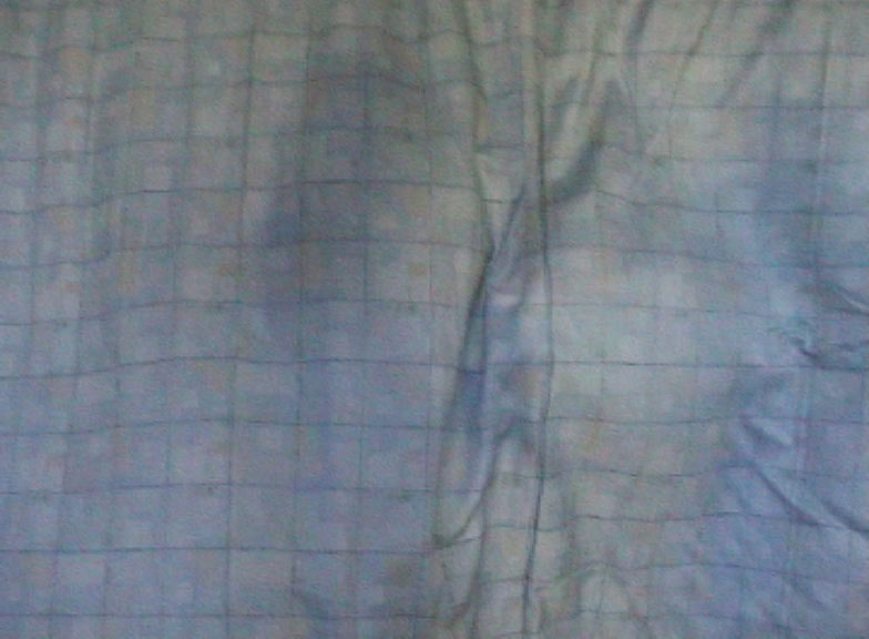 ITU, Harefield Hospital